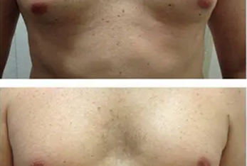 Gynecomastia male chest reduction surgery